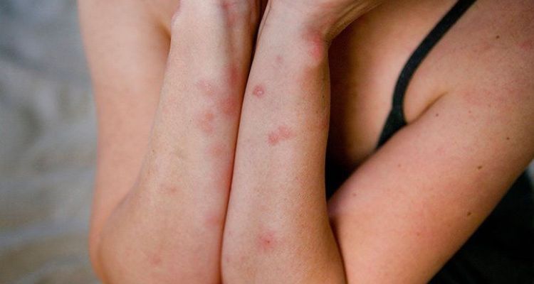 Bed Bug Bites vs. Shingles Symptoms and Sensations