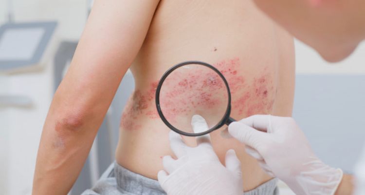 shingles as a viral infection